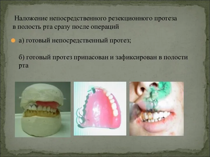 а) готовый непосредственный протез; б) готовый протез припасован и зафиксирован в