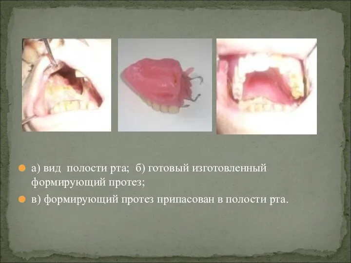 а) вид полости рта; б) готовый изготовленный формирующий протез; в) формирующий протез припасован в полости рта.