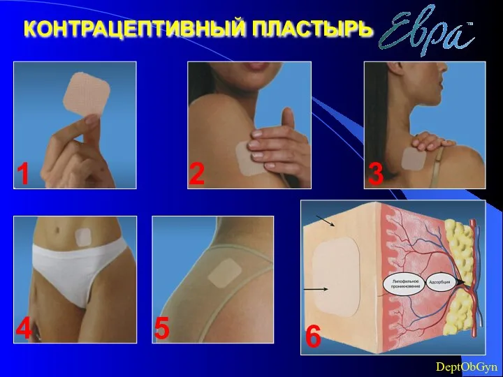 КОНТРАЦЕПТИВНЫЙ ПЛАСТЫРЬ 1 2 3 4 5 6 DeptObGyn