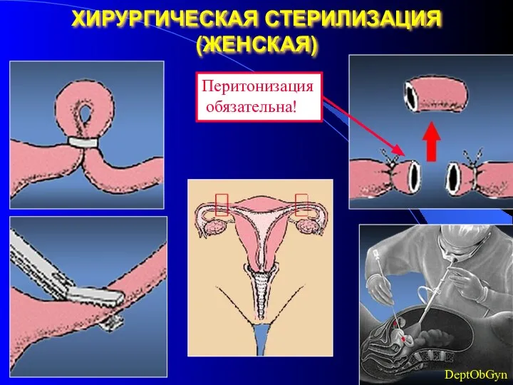 ХИРУРГИЧЕСКАЯ СТЕРИЛИЗАЦИЯ (ЖЕНСКАЯ) DeptObGyn Перитонизация обязательна! .