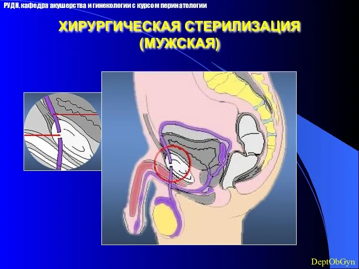 ХИРУРГИЧЕСКАЯ СТЕРИЛИЗАЦИЯ (МУЖСКАЯ) РУДН, кафедра акушерства и гинекологии с курсом перинатологии DeptObGyn