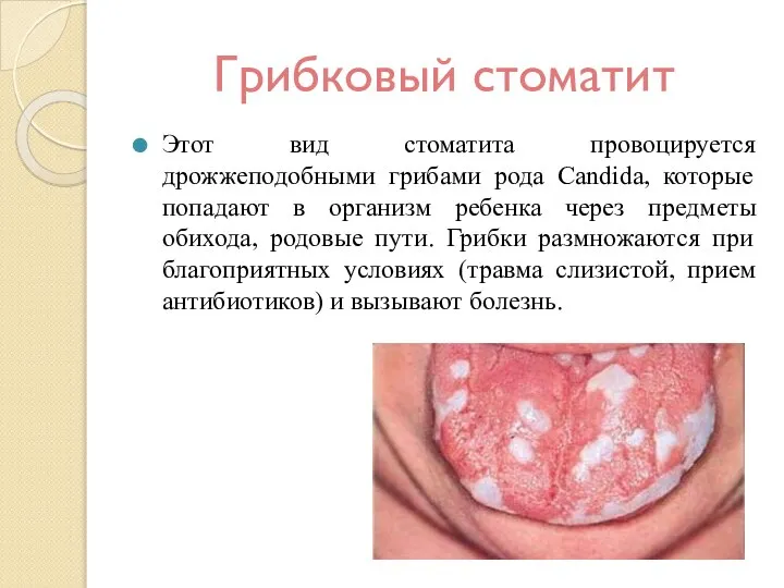 Грибковый стоматит Этот вид стоматита провоцируется дрожжеподобными грибами рода Candida, которые