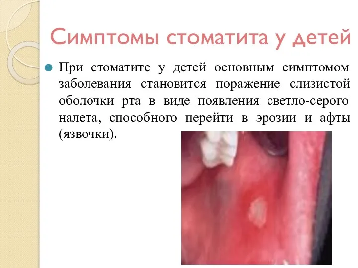 Симптомы стоматита у детей При стоматите у детей основным симптомом заболевания