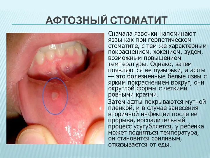 АФТОЗНЫЙ СТОМАТИТ пи Сначала язвочки напоминают язвы как при герпетическом стоматите,