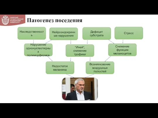 Патогенез поседения Возникновение воздушных полостей Недостаток меланина Снижение функции меланоцитов “Иней”,