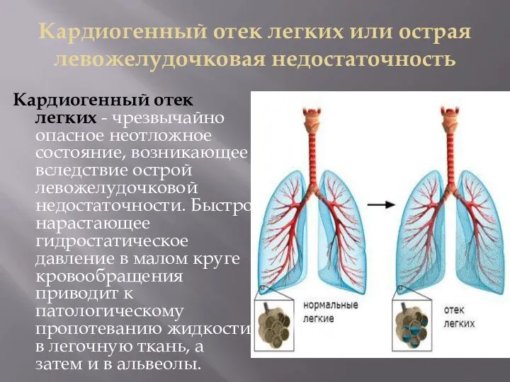 Кардиогенный отек легких или острая левожелудочковая недостаточность Кардиогенный отек легких -