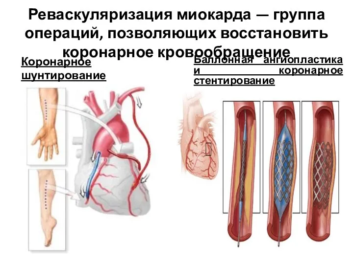 Реваскуляризация миокарда — группа операций, позволяющих восстановить коронарное кровообращение Коронарное шунтирование Баллонная ангиопластика и коронарное стентирование