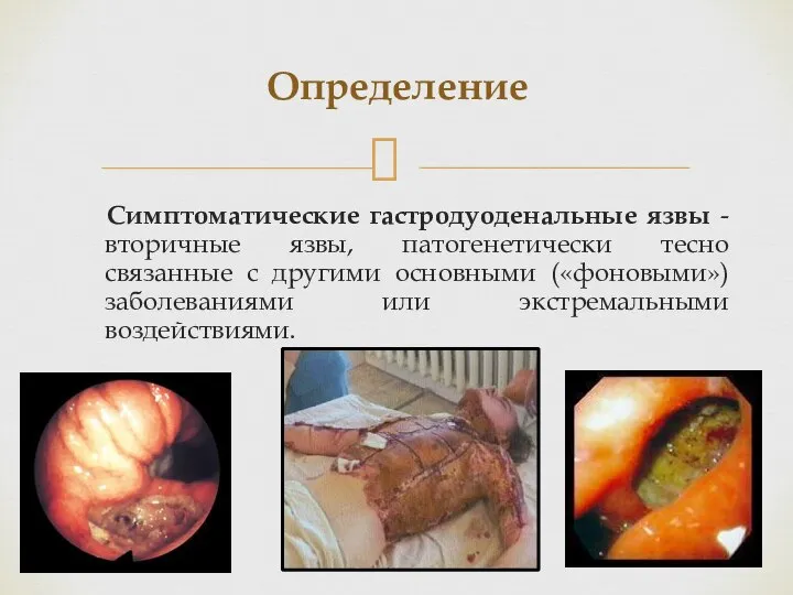 Определение Симптоматические гастродуоденальные язвы - вторичные язвы, патогенетически тесно связанные с