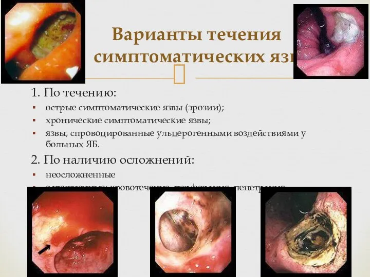 Варианты течения симптоматических язв 1. По течению: острые симптоматические язвы (эрозии);