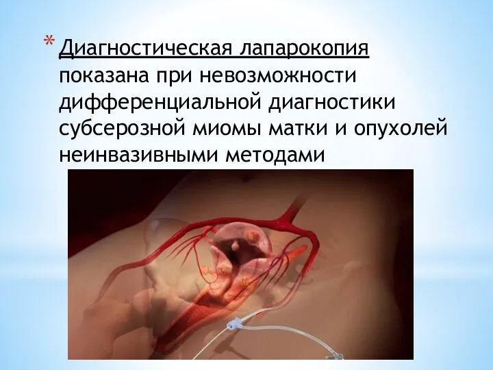 Диагностическая лапарокопия показана при невозможности дифференциальной диагностики субсерозной миомы матки и опухолей неинвазивными методами