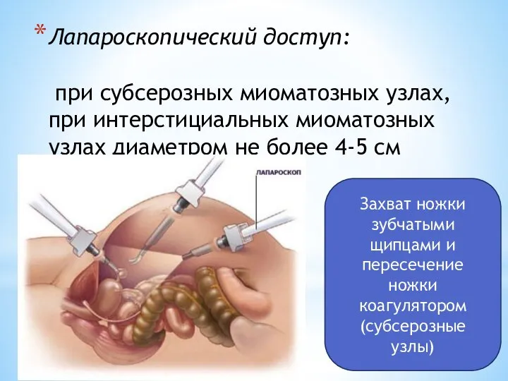 Лапароскопический доступ: при субсерозных миоматозных узлах, при интерстициальных миоматозных узлах диаметром