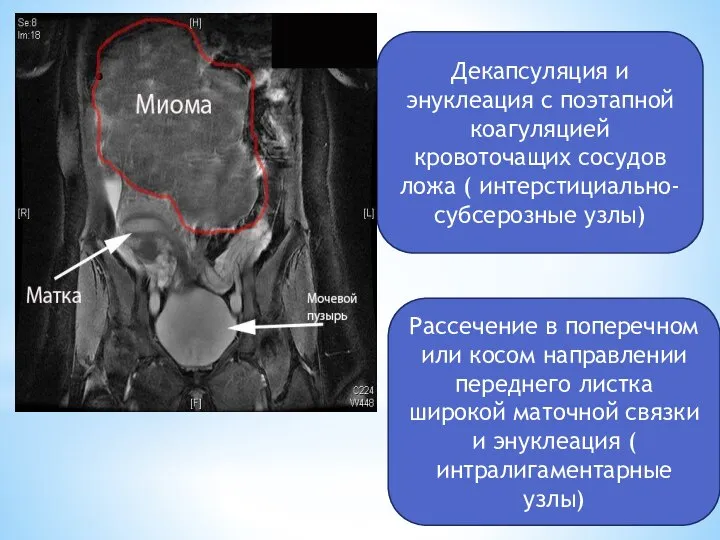 Декапсуляция и энуклеация с поэтапной коагуляцией кровоточащих сосудов ложа ( интерстициально-субсерозные