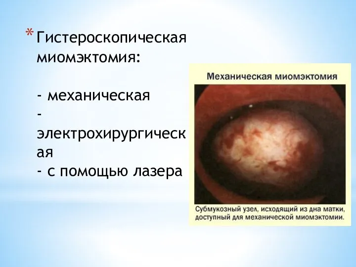 Гистероскопическая миомэктомия: - механическая - электрохирургическая - с помощью лазера