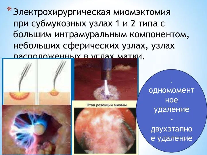 Электрохирургическая миомэктомия при субмукозных узлах 1 и 2 типа с большим