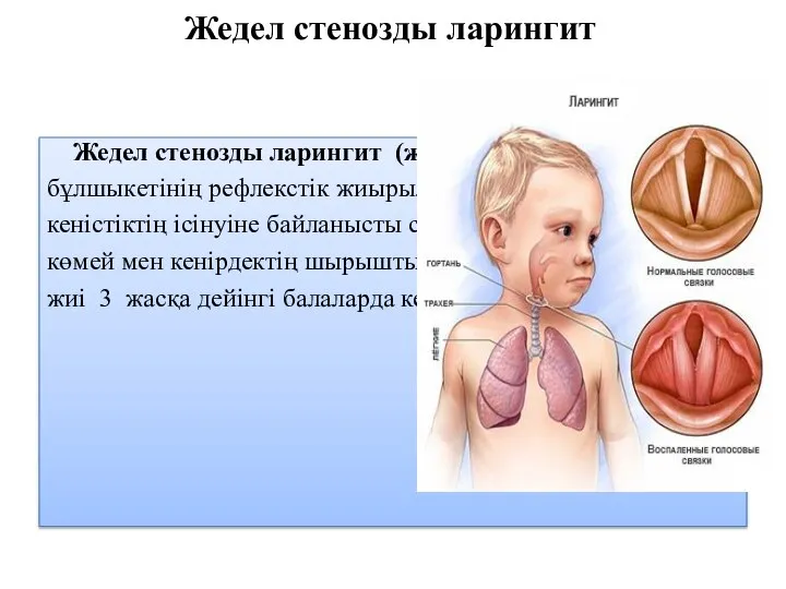 Жедел стенозды ларингит Жедел стенозды ларингит (жалған круп) – көмей бұлшыкетінің