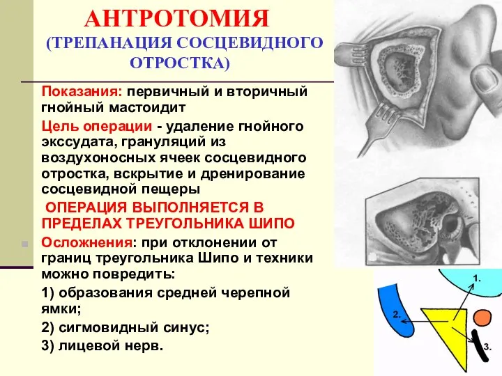 АНТРОТОМИЯ (ТРЕПАНАЦИЯ СОСЦЕВИДНОГО ОТРОСТКА) Показания: первичный и вторичный гнойный мастоидит Цель