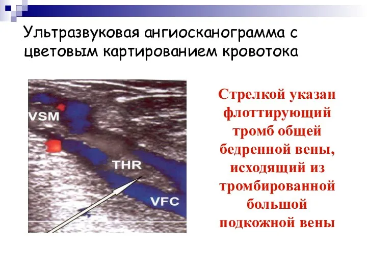 Ультразвуковая ангиосканограмма с цветовым картированием кровотока Стрелкой указан флоттирующий тромб общей