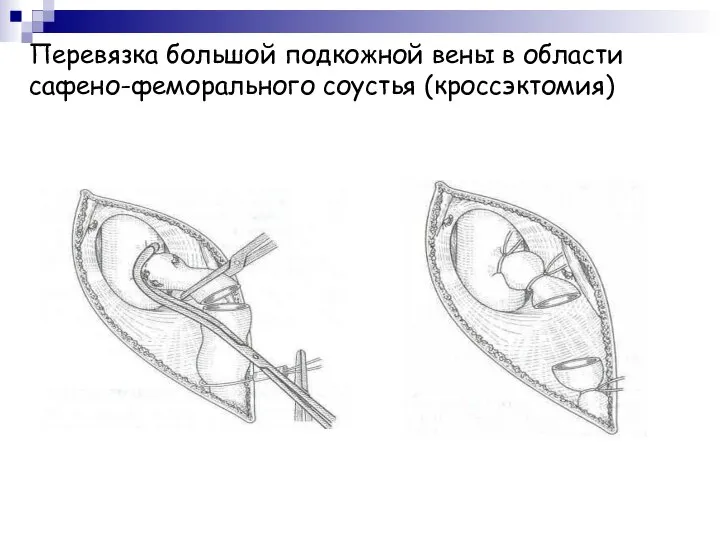 Перевязка большой подкожной вены в области сафено-феморального соустья (кроссэктомия)