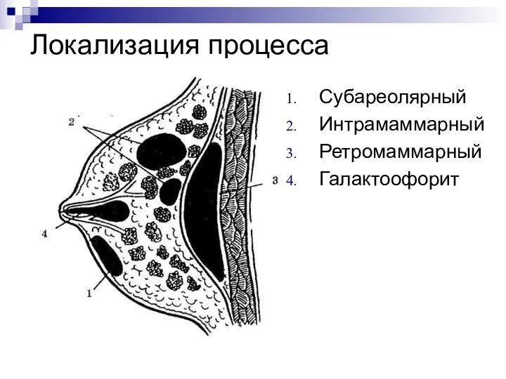 Локализация процесса Субареолярный Интрамаммарный Ретромаммарный Галактоофорит