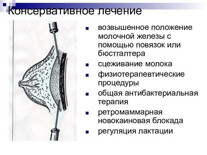 Консервативное лечение возвышенное положение молочной железы с помощью повязок или бюстгалтера