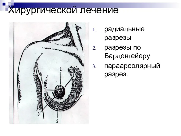 Хирургической лечение радиальные разрезы разрезы по Барденгейеру параареолярный разрез.