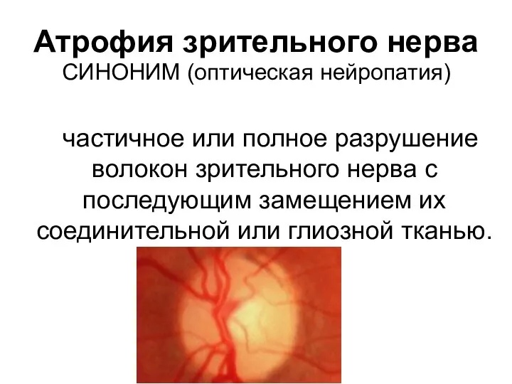 Атрофия зрительного нерва СИНОНИМ (оптическая нейропатия) частичное или полное разрушение волокон