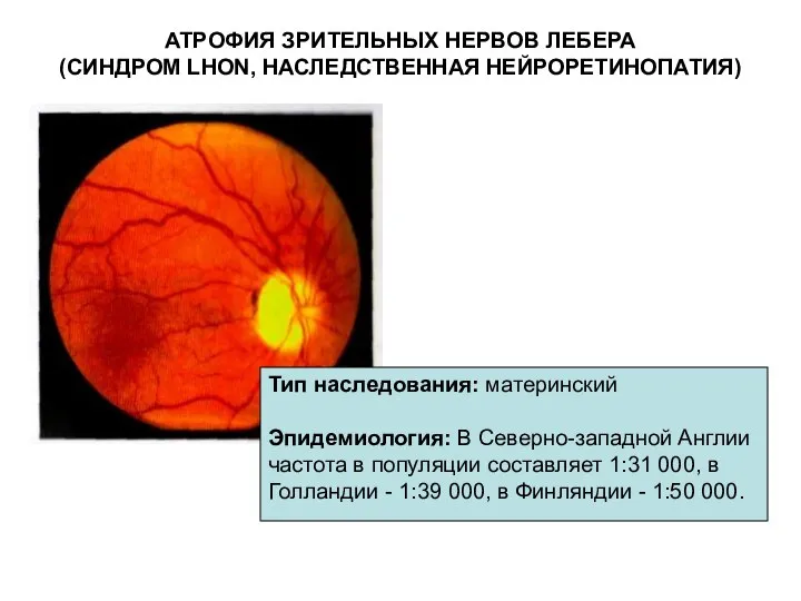 АТРОФИЯ ЗРИТЕЛЬНЫХ НЕРВОВ ЛЕБЕРА (СИНДРОМ LHON, НАСЛЕДСТВЕННАЯ НЕЙРОРЕТИНОПАТИЯ) Тип наследования: материнский