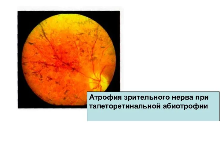 Атрофия зрительного нерва при тапеторетинальной абиотрофии