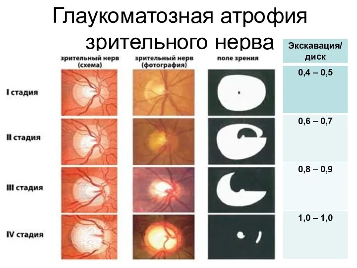 Глаукоматозная атрофия зрительного нерва