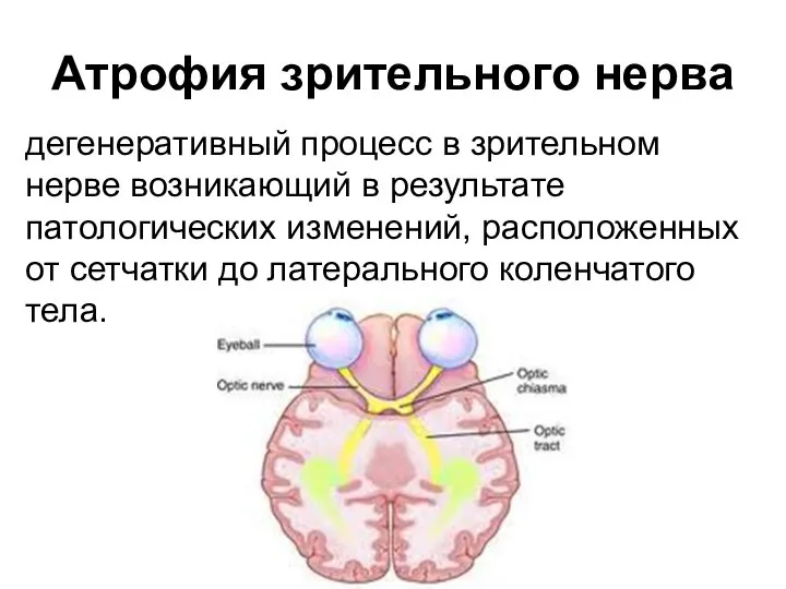 Атрофия зрительного нерва дегенеративный процесс в зрительном нерве возникающий в результате
