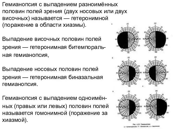 Гемианопсия с выпадением разноимённых половин полей зрения (двух носовых или двух