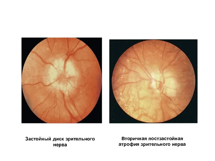 Вторичная постзастойная атрофия зрительного нерва