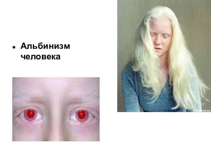 Альбинизм человека