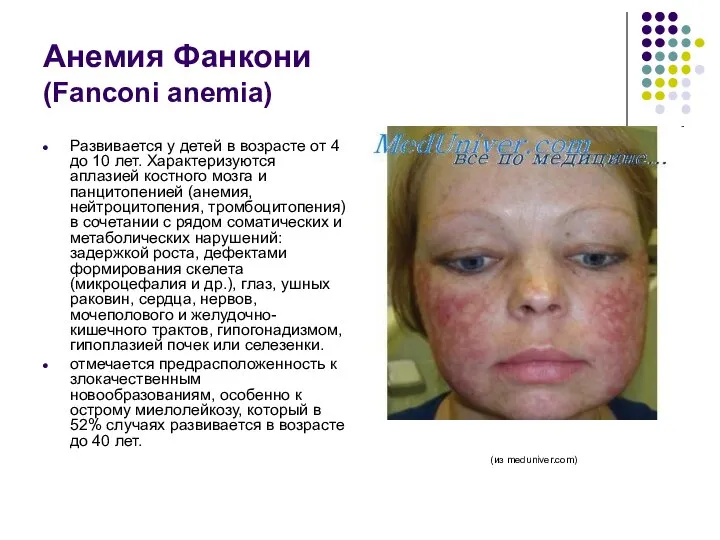 Анемия Фанкони (Fanconi anemia) Развивается у детей в возрасте от 4