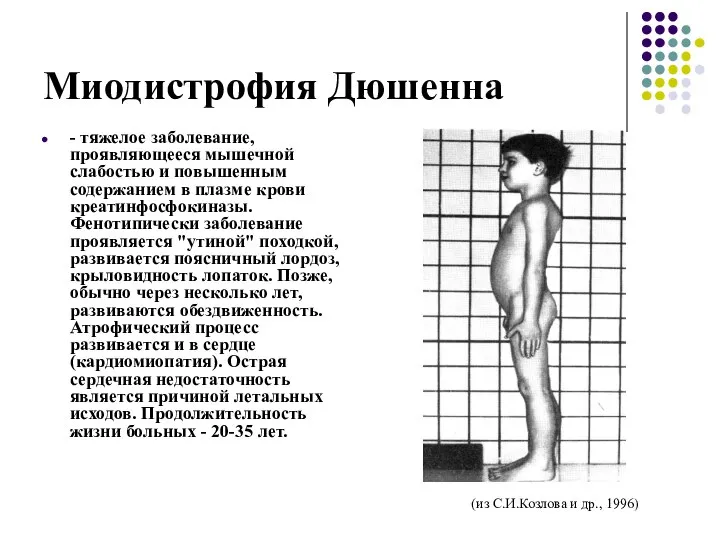 Миодистрофия Дюшенна - тяжелое заболевание, проявляющееся мышечной слабостью и повышенным содержанием