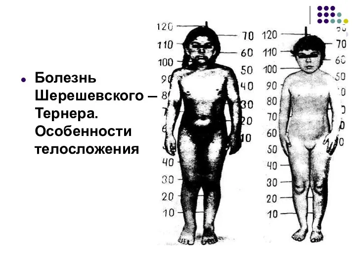 Болезнь Шерешевского — Тернера. Особенности телосложения