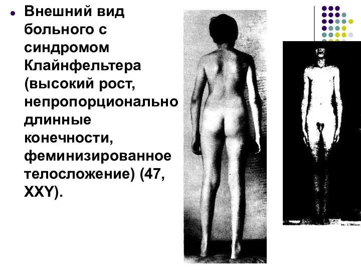 Внешний вид больного с синдромом Клайнфельтера (высокий рост, непропорционально длинные конечности, феминизированное телосложение) (47, XXY).