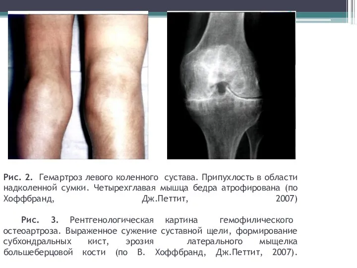 Рис. 2. Гемартроз левого коленного сустава. Припухлость в области надколенной сумки.