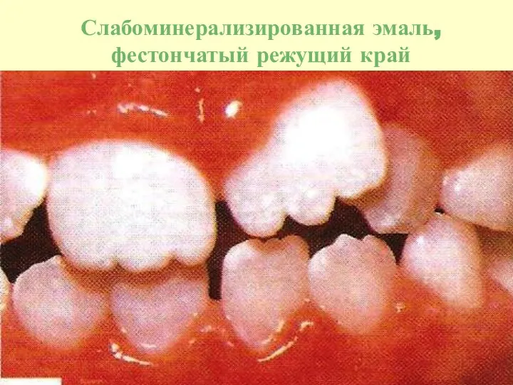 Слабоминерализированная эмаль, фестончатый режущий край