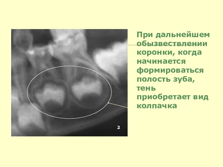 При дальнейшем обызвествлении коронки, когда начинается формироваться полость зуба, тень приобретает вид колпачка