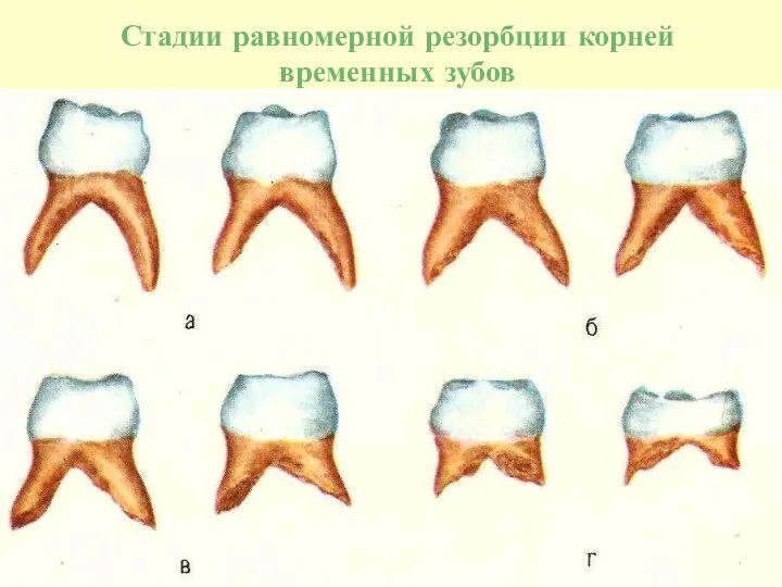 Стадии равномерной резорбции корней временных зубов