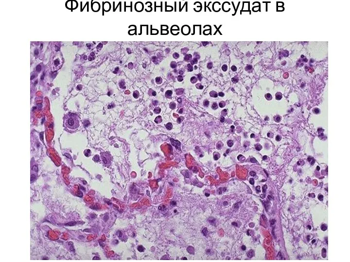 Фибринозный экссудат в альвеолах