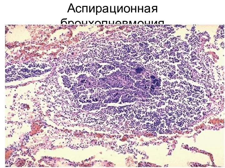 Аспирационная бронхопневмония