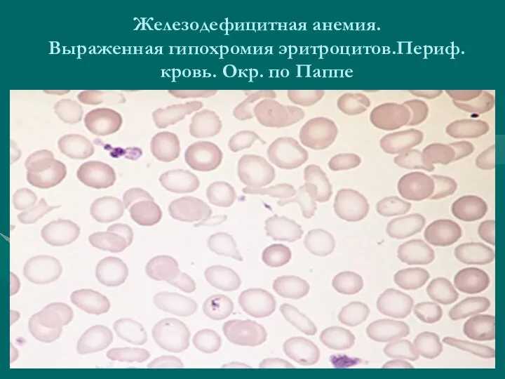 Железодефицитная анемия. Выраженная гипохромия эритроцитов.Периф. кровь. Окр. по Паппе