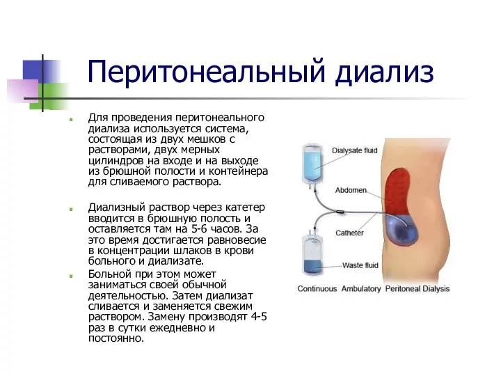 Перитонеальный диализ Для проведения перитонеального диализа используется система, состоящая из двух