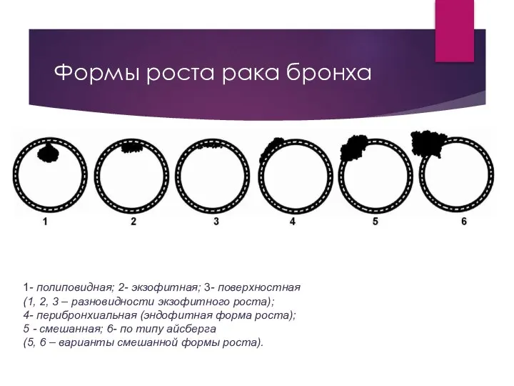 Формы роста рака бронха 1- полиповидная; 2- экзофитная; 3- поверхностная (1,