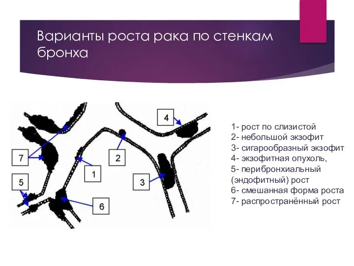 Варианты роста рака по стенкам бронха 1- рост по слизистой 2-