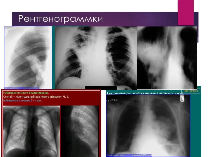 Рентгенограммки Центральный рак перибронхиальный инфильтративный