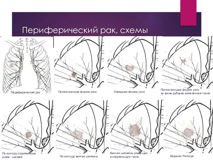 Периферический рак, схемы .Периферический рак Полигональная форма узла Овоидная форма узла