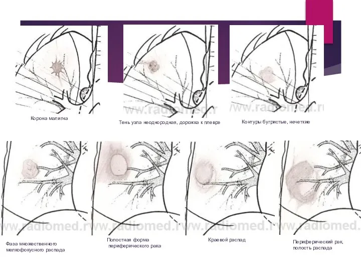 Корона малигна Тень узла неоднородная, дорожка к плевре Контуры бугристые, нечеткие